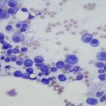 ngan-chan-di-can-ung-thu-bang-quang-bang-thuoc-tri-cam-lanh